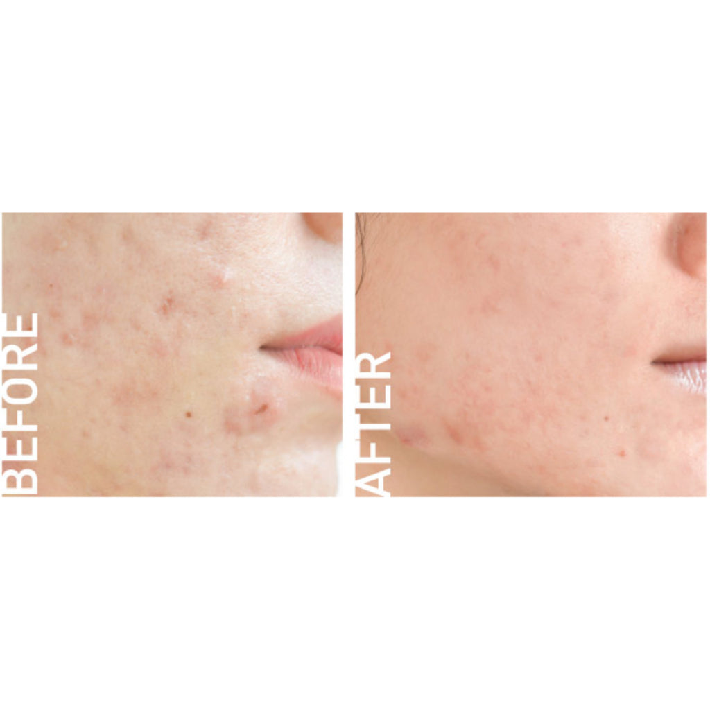 [SG INSTOCK] BABY BRIGHT CLEAR ACNE GEL ,ACNE SPOT DRAGON BLOOD GEL 15G