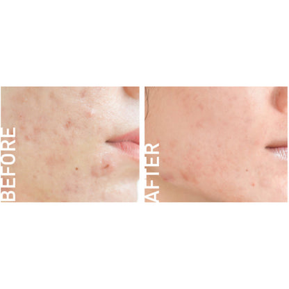 [SG INSTOCK] BABY BRIGHT CLEAR ACNE GEL ,ACNE SPOT DRAGON BLOOD GEL 15G