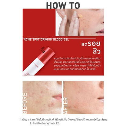 [SG INSTOCK] BABY BRIGHT CLEAR ACNE GEL ,ACNE SPOT DRAGON BLOOD GEL 15G